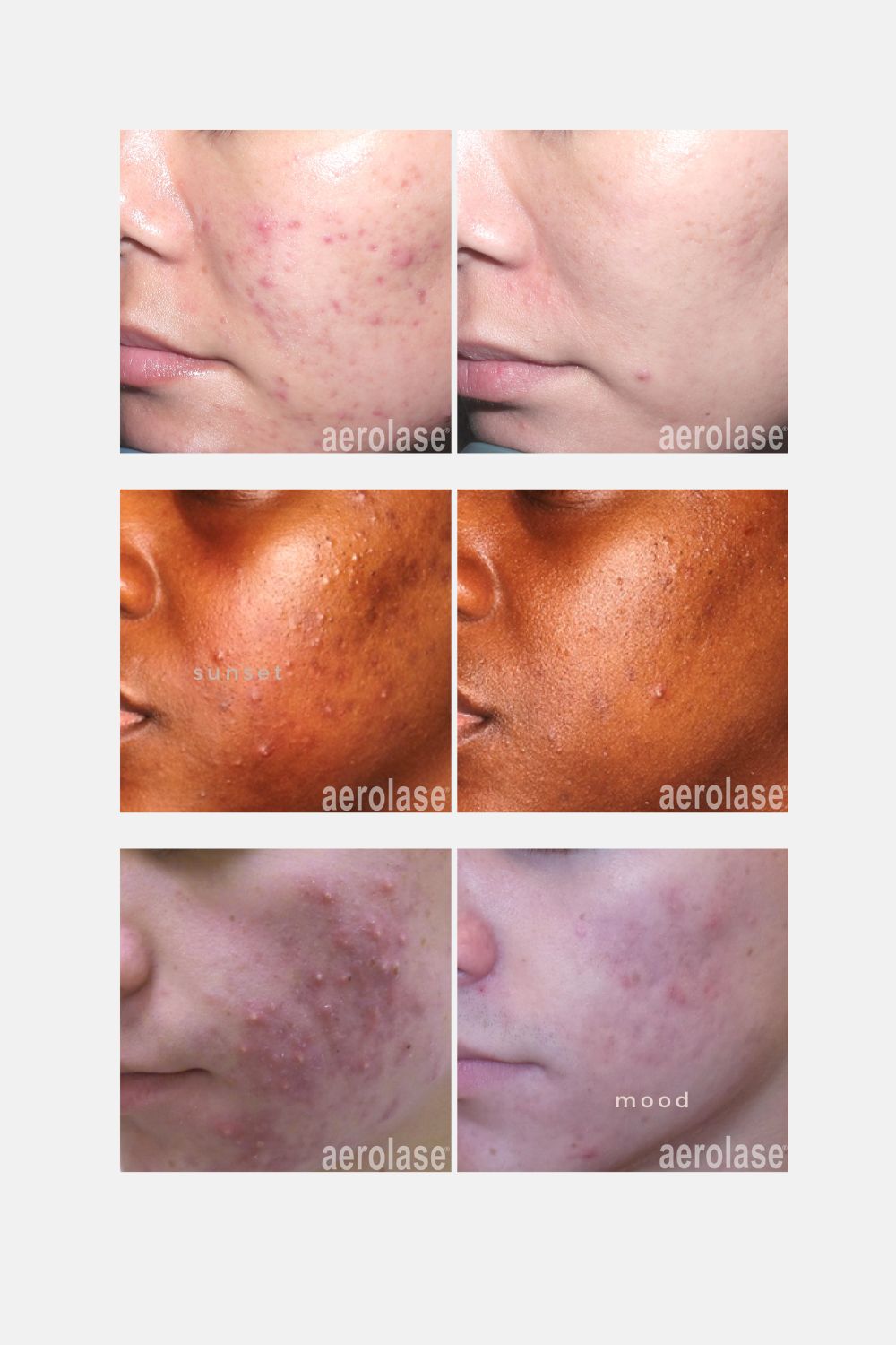 Neoclear Trial Services – The Skin Bar New Orleans