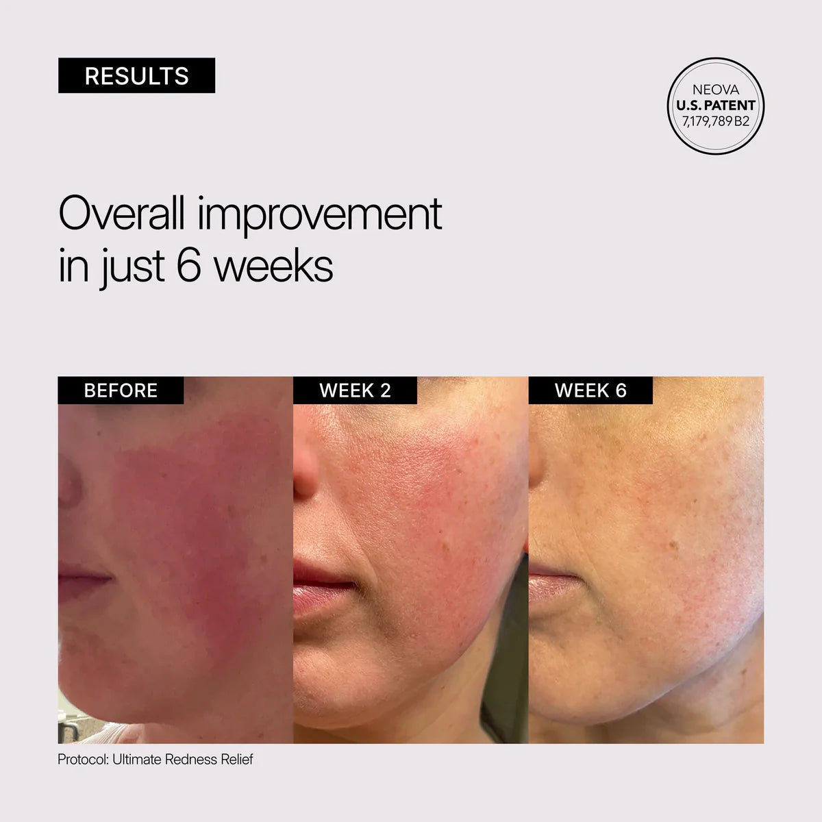 Neova Ultimate Redness Relief
